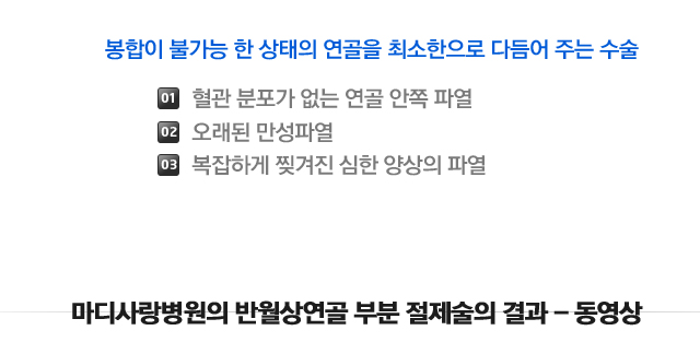 반월상연골파열