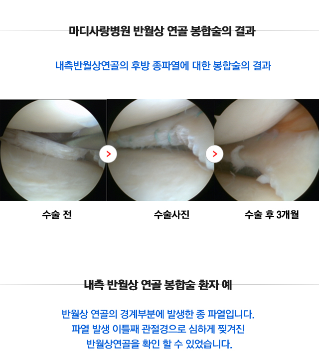 반월상연골파열