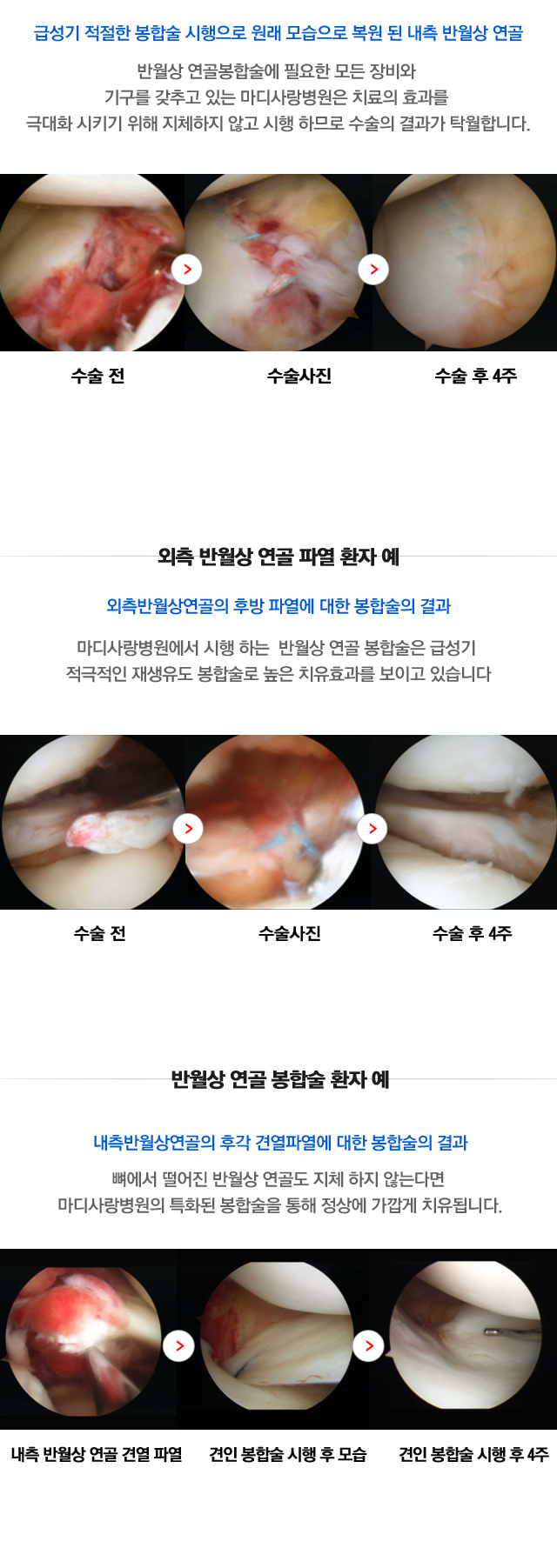 반월상연골파열