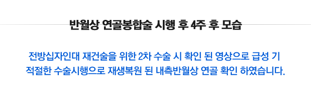 반월상연골파열