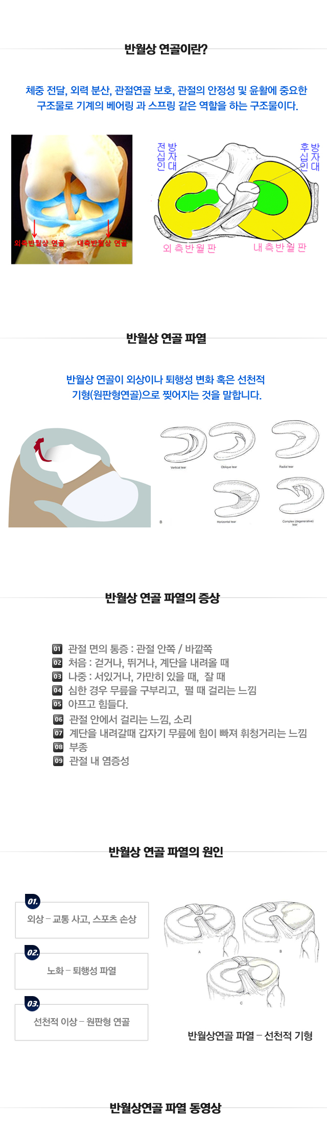 반월상연골파열