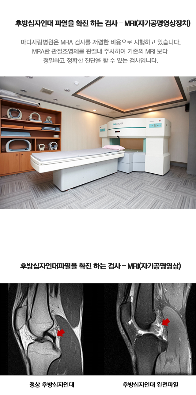 후방십자인대파열