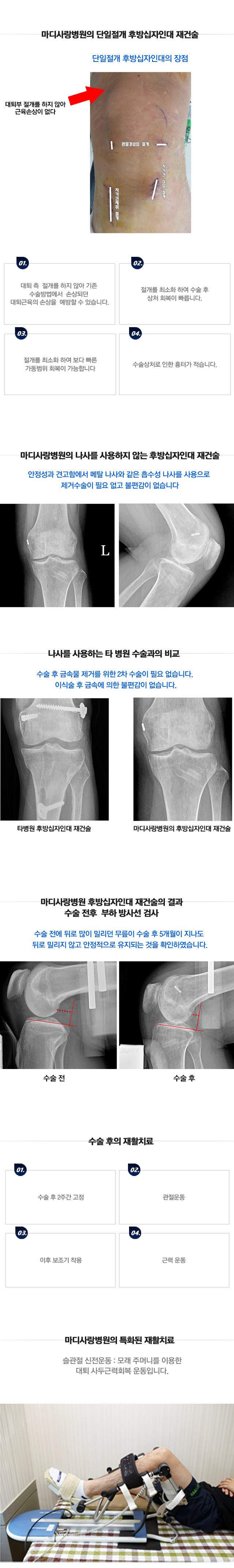 후방십자인대파열