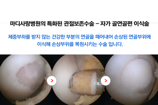 퇴행성관절염