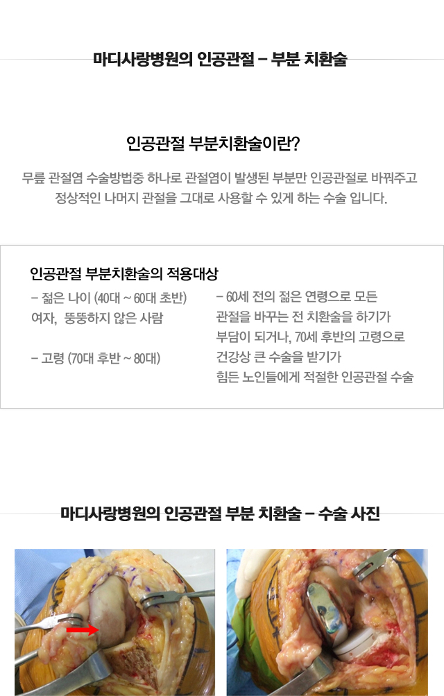 퇴행성관절염