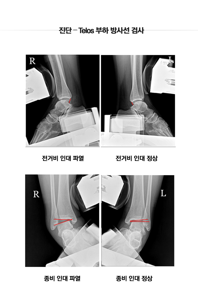 외측 불안정성