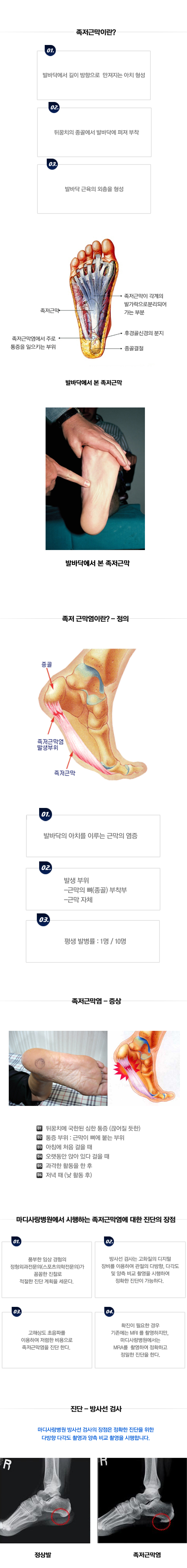 족저근막염