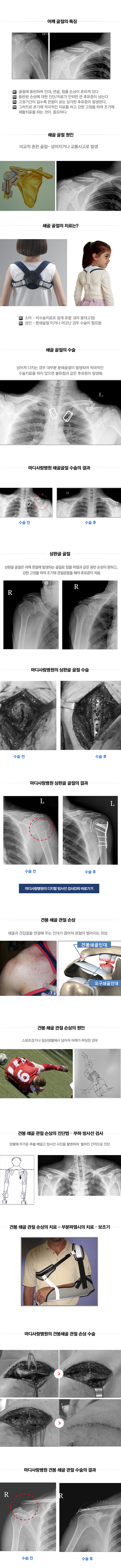 관절주위골절(어깨)