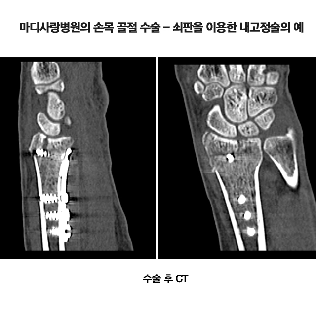 관절주위골절(손목)