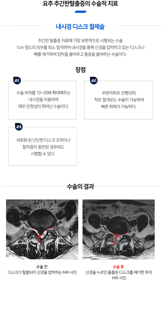 요추추간판탈출증