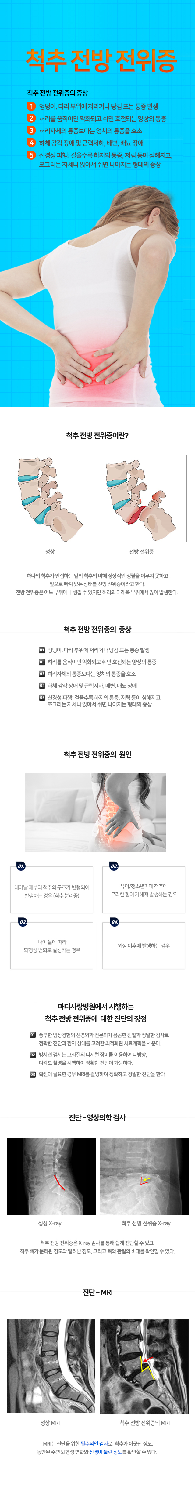 척추전방전위증