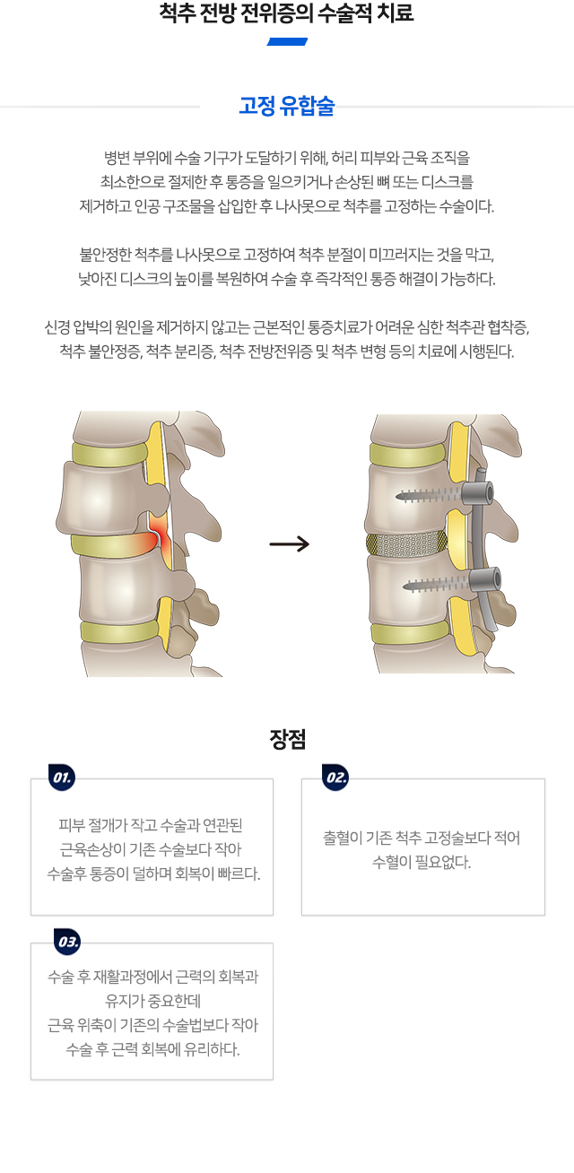 척추전방전위증