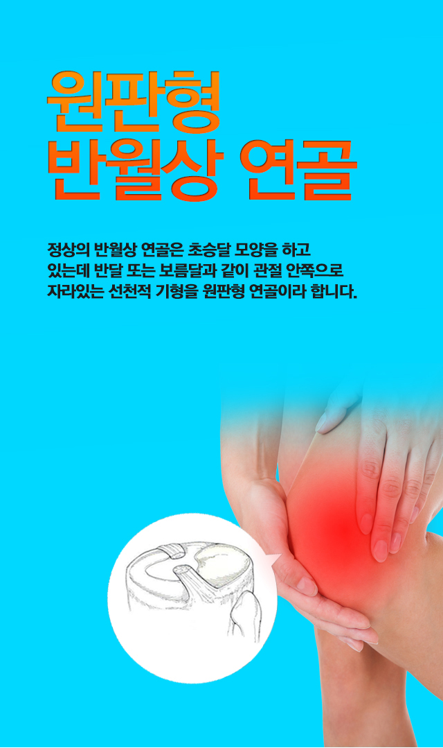 원판형 반월상 연골 파열