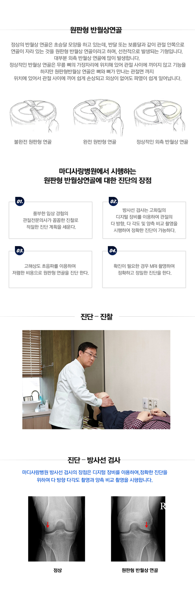 원판형 반월상 연골 파열