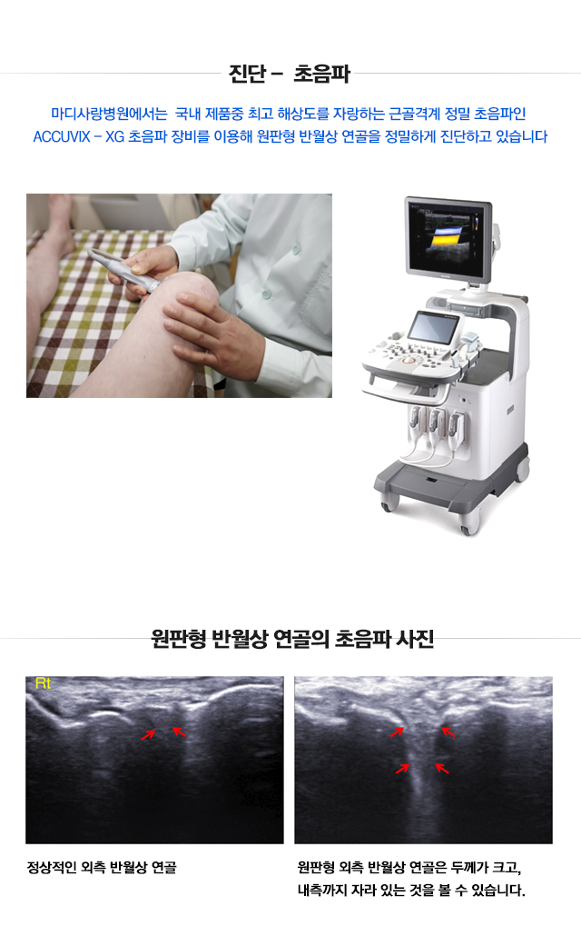 원판형 반월상 연골 파열