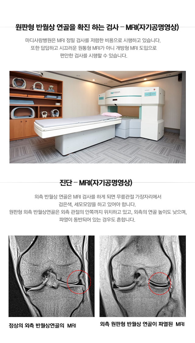 원판형 반월상 연골 파열