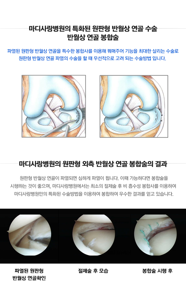 원판형 반월상 연골 파열