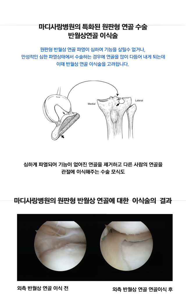 원판형 반월상 연골 파열