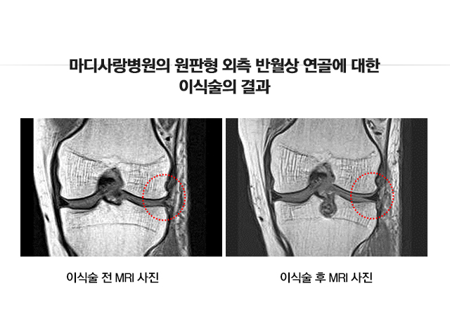 원판형 반월상 연골 파열