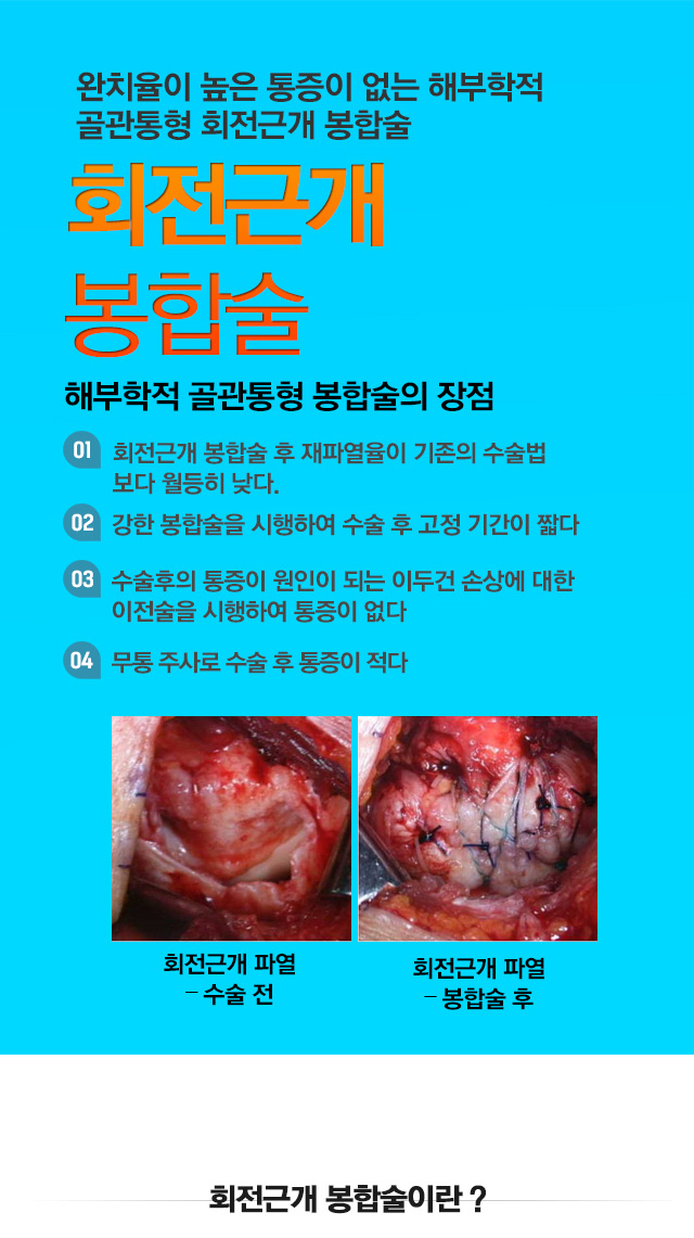 회전근개질환