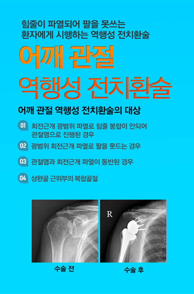 어깨 관절 역행성 전치환술