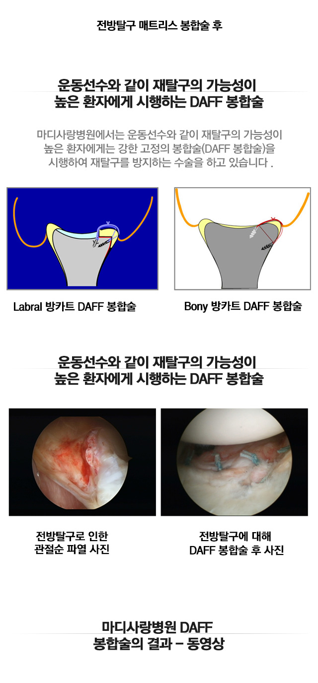 외상성 탈구