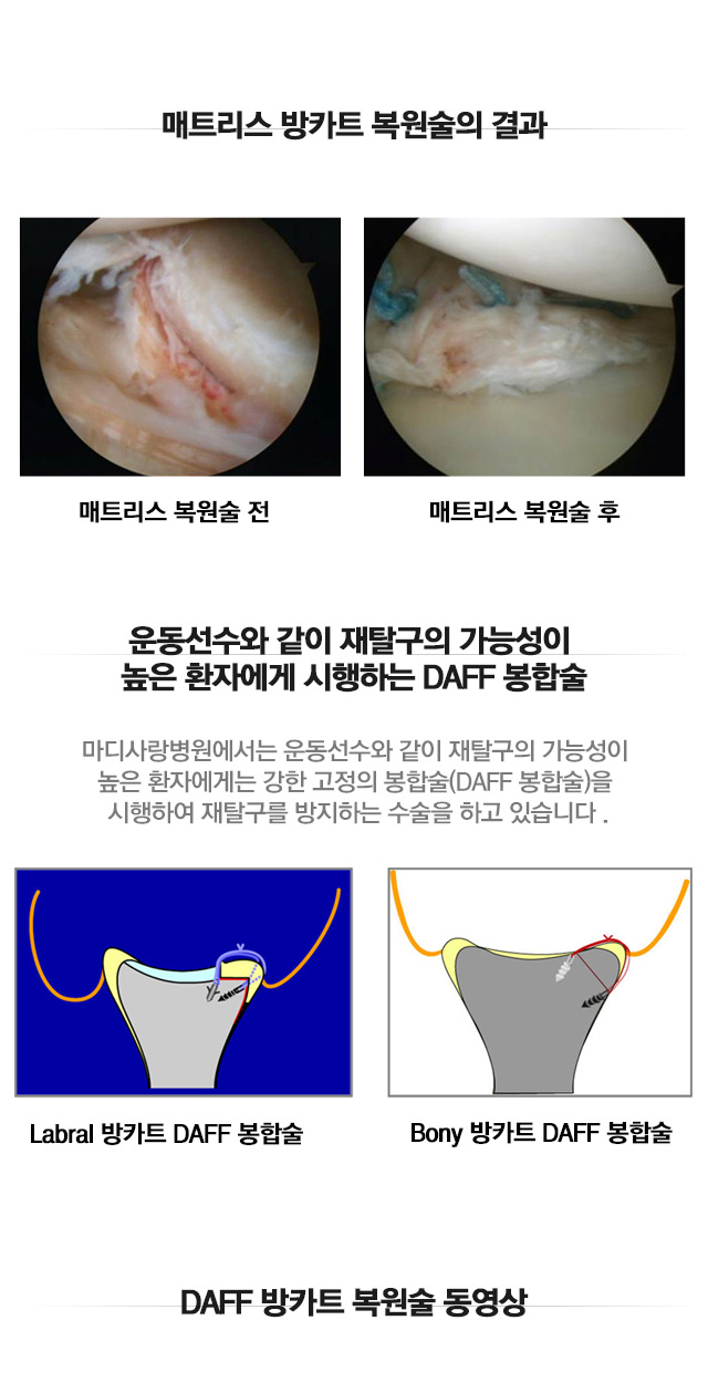 습관성 탈구