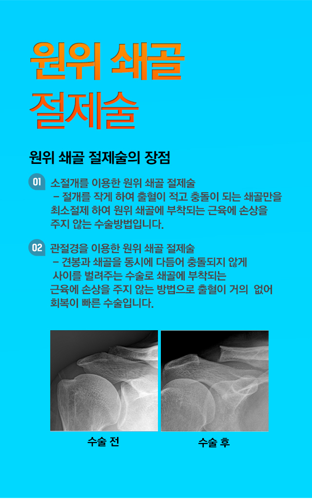 원위 쇄골 절제술