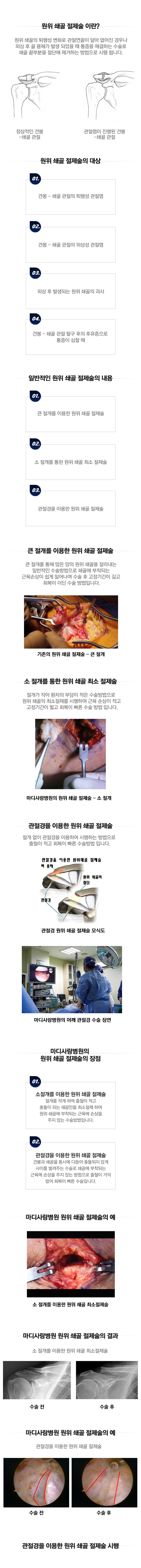 원위 쇄골 절제술