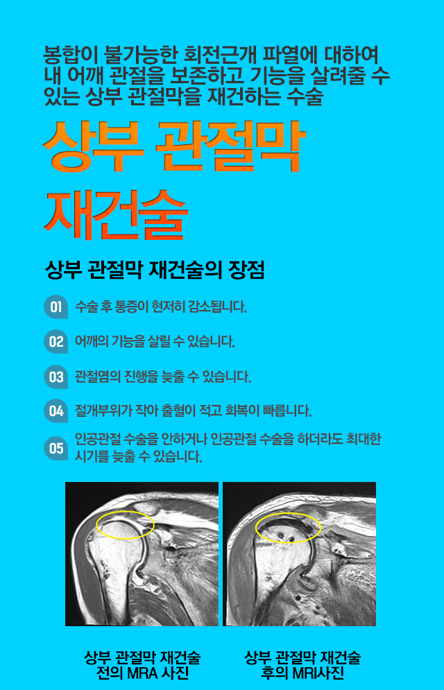 상부관절막재건술