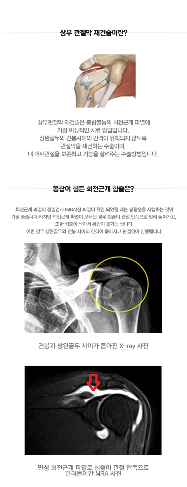 상부관절막재건술