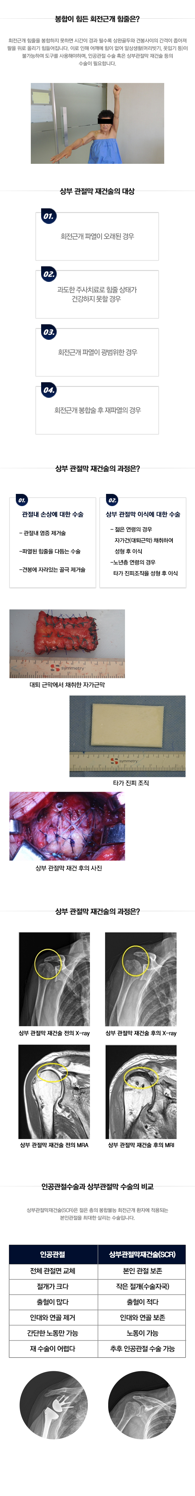 상부관절막재건술)