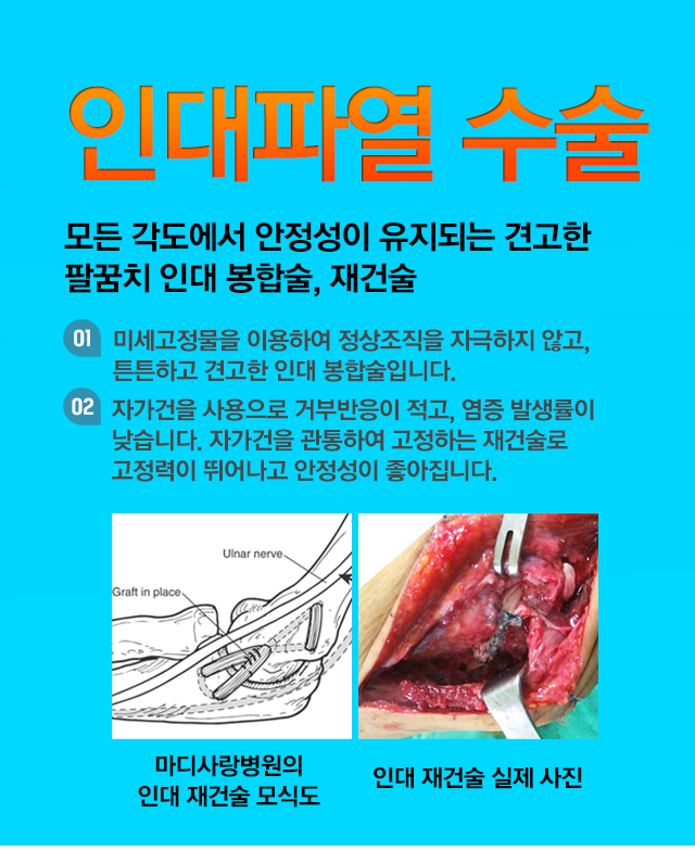 인대파열 수술