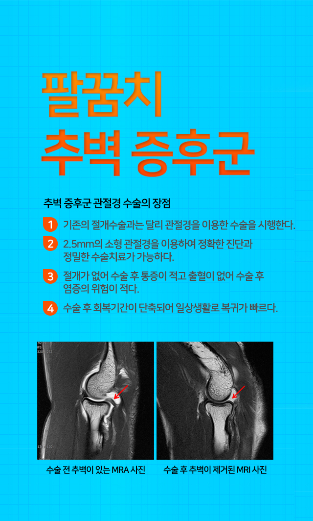 팔꿈치 추벽 증후군