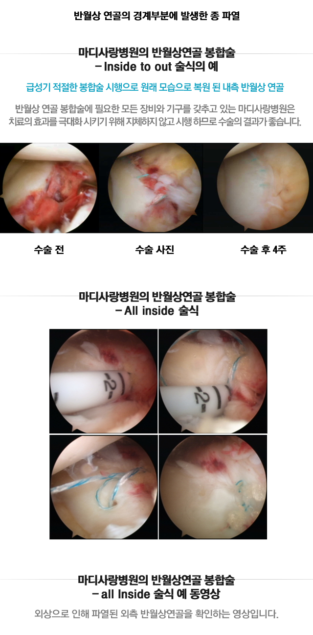 반월상연골 견인봉합술