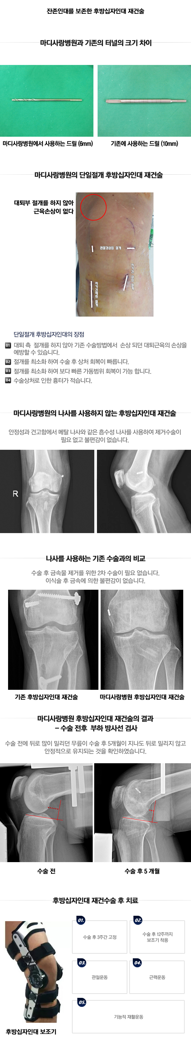 관절연골 재생 수술