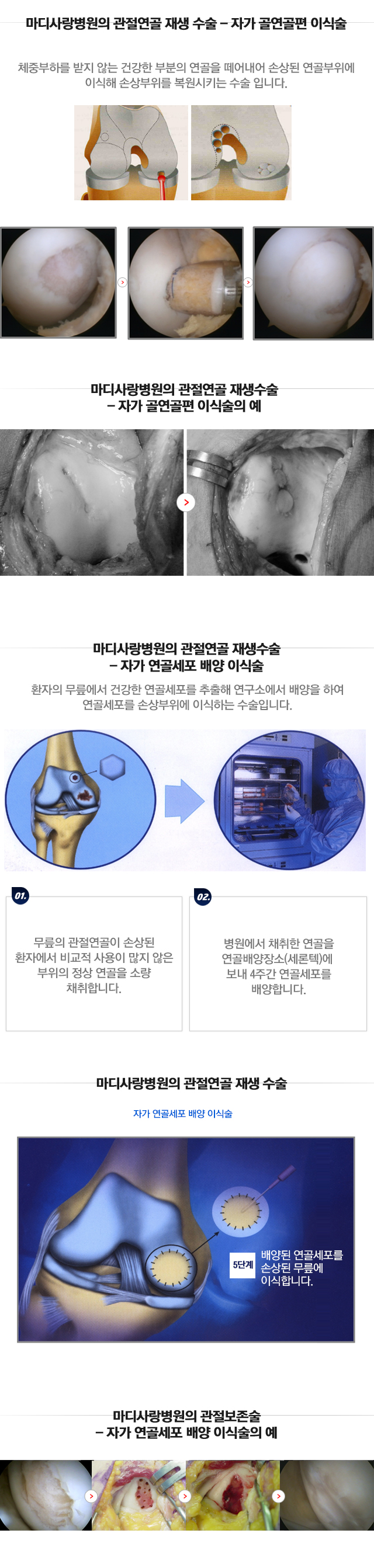 관절연골 재생수술