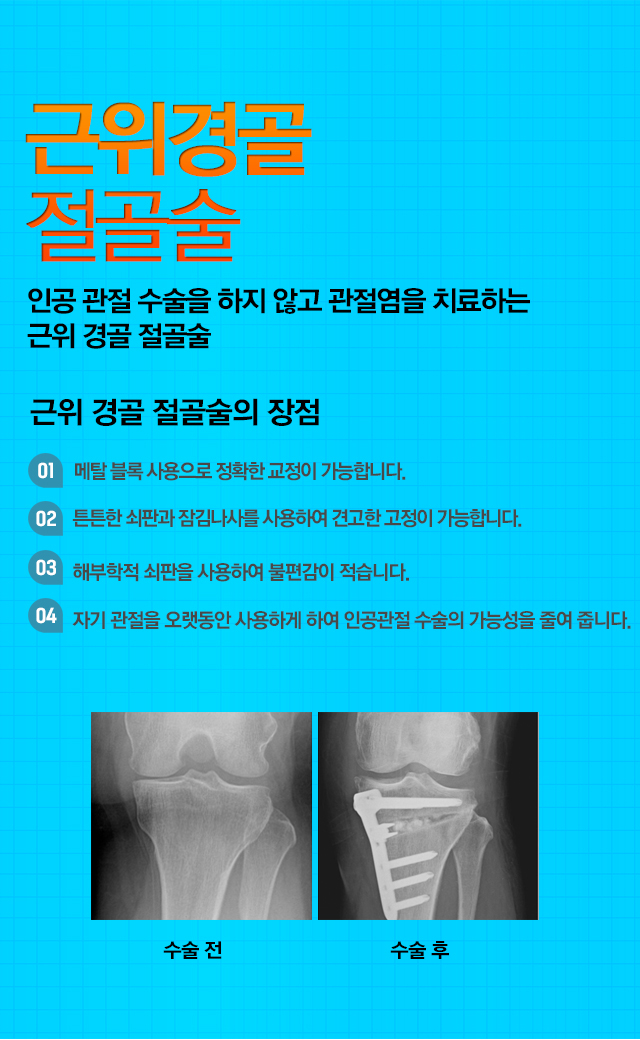 인공관절 부분치환술