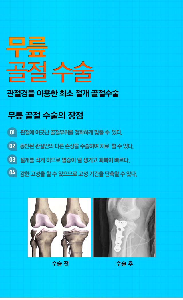 무릎 골절수술