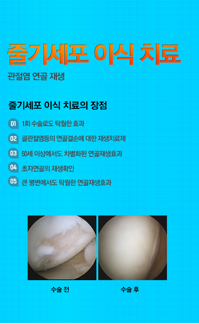 줄기세포치료제