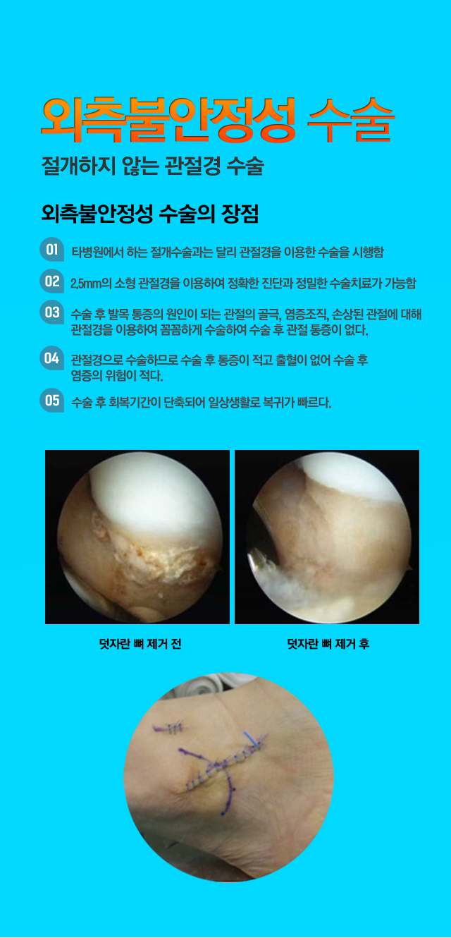 외측불안정성 수술