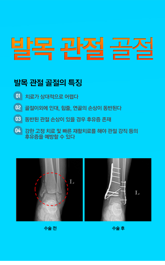 발목 골절수술