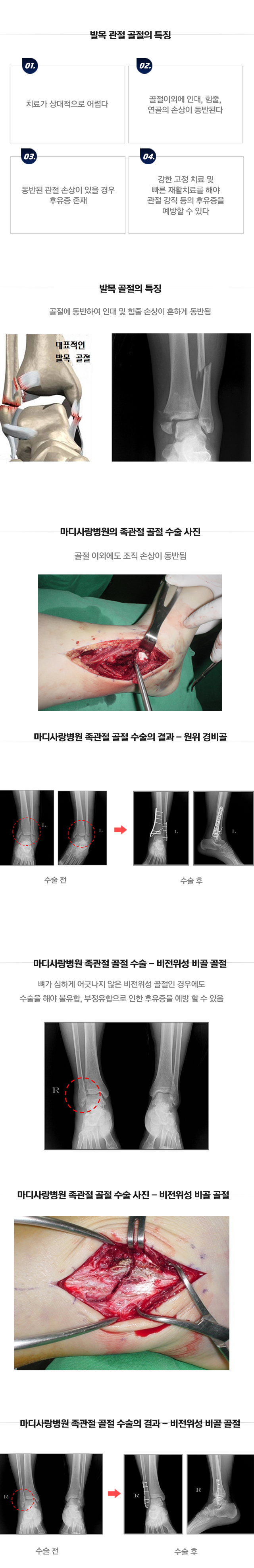 발목 골절수술