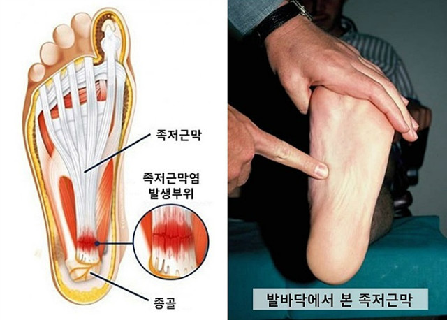 가산디지털단지 성형외과 발바닥 통증에 진절머리가 났다면?