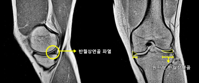 반월상 연골 손상 MRI 이미지