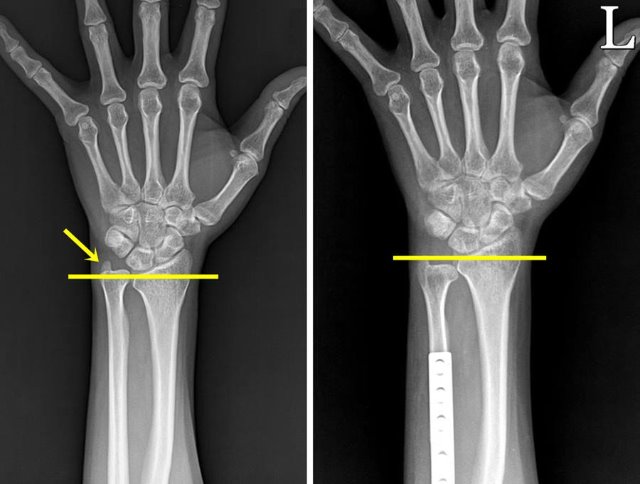 수술 전, 후 x-ray 비교.jpg