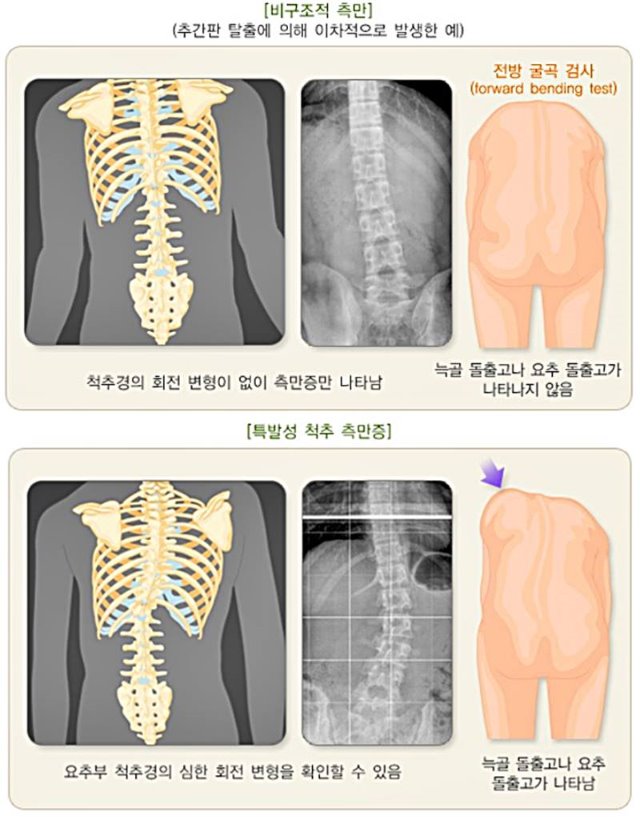 마디사랑병원 ㅣ 관절, 척추, 재활, 줄기세포 - 커뮤니티 > 마디사랑병원블로그