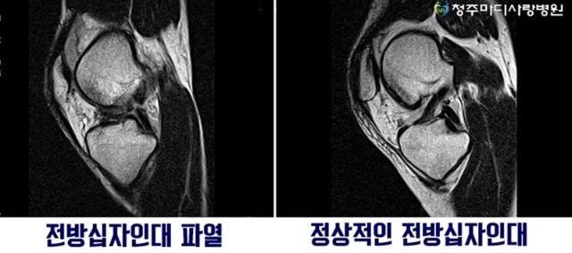 전방십자인대파열 MRI.jpg