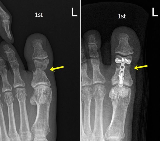 발가락 골절 수술 전,후.jpg