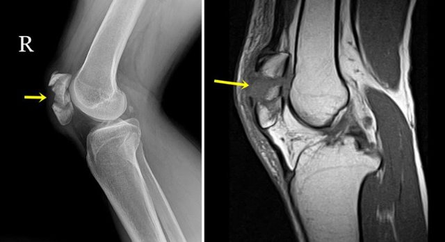 슬개골 골절.jpg